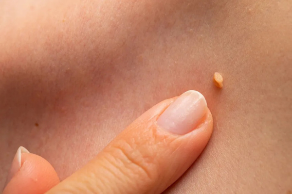 VPH: qué es, cómo se transmite y qué estudios permiten detectarlo